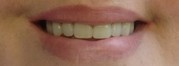 Dental Treatments in Limerick - Bowe Dental Clinic